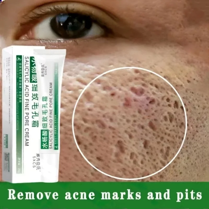 살리실산 모공 클리어링 크림 모공 축소 블랙헤드 제거  - Azelaic Acid Cream 리뷰 및 가격